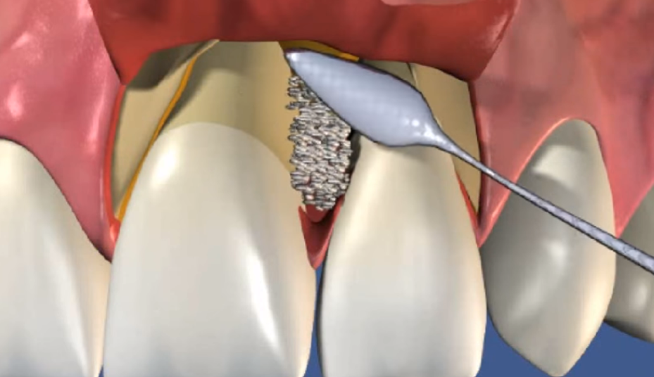 Операции по сохранению зубов